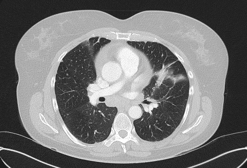 File:Cardiac sarcoidosis (Radiopaedia 74548-85534 Axial lung window 40).jpg