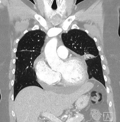 Cardiac sarcoidosis (Radiopaedia 74548-85534 Coronal lung window 22).jpg