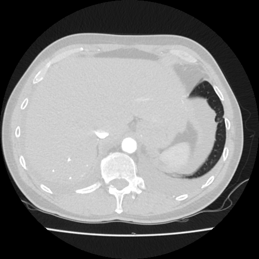 Cardiac tamponade (Radiopaedia 78607-91368 Axial lung window 86).jpg