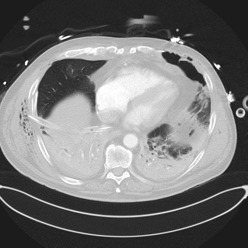 Cardiac trauma (Radiopaedia 32874-33858 Axial lung window 39).jpg