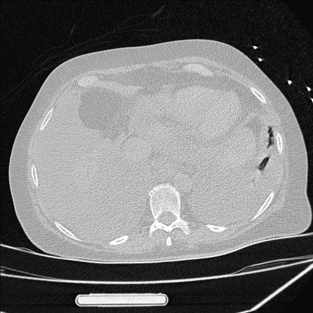 Cardiogenic pulmonary edema (Radiopaedia 29213-29609 Axial lung window 82).jpg