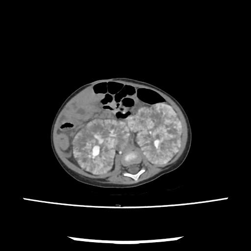 Caroli disease with autosomal recessive polycystic kidney disease (ARPKD) (Radiopaedia 89651-106703 E 140).jpg