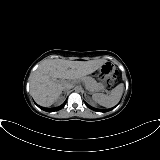 Caroli disease with medullary sponge kidney (Radiopaedia 82622-96804 Axial non-contrast 20).jpg