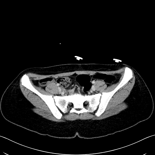 Caroli disease with medullary sponge kidney (Radiopaedia 82622-96804 C 58).jpg