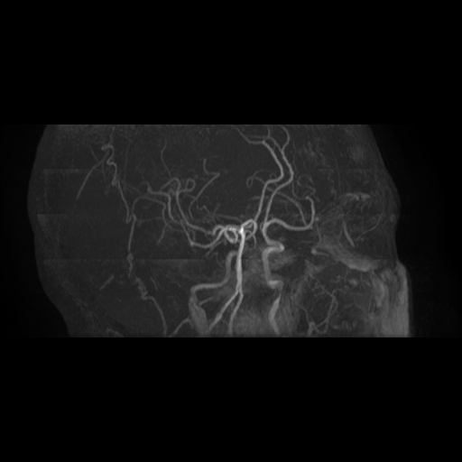 Carotid arterial dissection with acute cerebral infarction (Radiopaedia 26636-26784 MRA 15).jpg