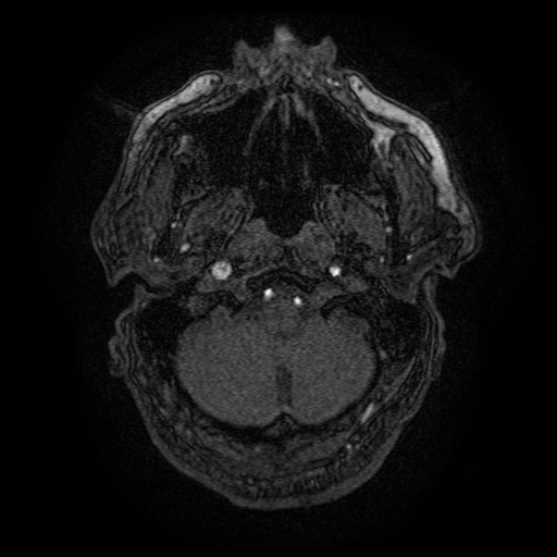 Carotid arterial dissection with acute cerebral infarction (Radiopaedia 26636-26784 MRA 159).jpg