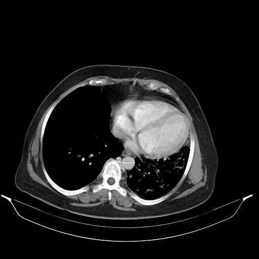 File:Carotid body tumor (Radiopaedia 21021-20948 A 44).jpg