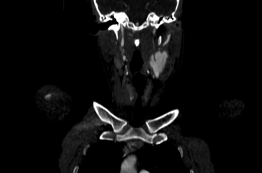 File:Carotid bulb pseudoaneurysm (Radiopaedia 57670-64616 D 13).jpg