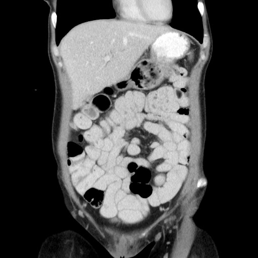 Castleman disease with fibrous pseudotumor in the abdomen (Radiopaedia 77296-89373 B 25).jpg