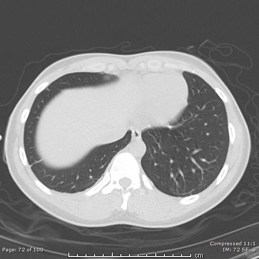 Catamenial pneumothorax (Radiopaedia 54382-60600 Axial non-contrast 72).jpg