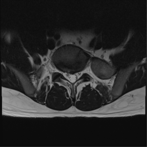 File:Cauda equina syndrome (Radiopaedia 53615-59672 Axial T2 7).png