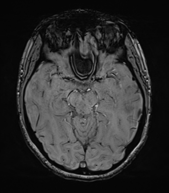 File:Cavernoma with bleed - midbrain (Radiopaedia 54546-60773 Axial SWI 20).png