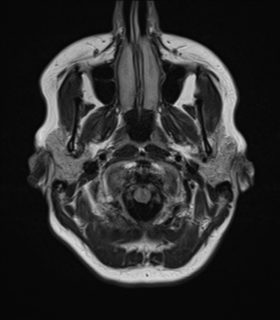 File:Cavernoma with bleed - midbrain (Radiopaedia 54546-60774 Axial FLAIR 3).png