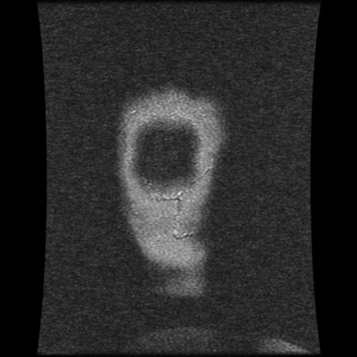 Cavernoma with developmental venous anomaly (Radiopaedia 22470-22507 MRV 20).jpg