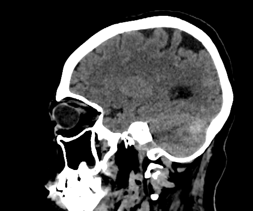 Cavernous hemangioma of the cerebellar falx (Radiopaedia 73025-83723 B 103).jpg