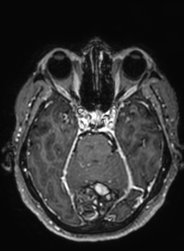 Cavernous hemangioma of the cerebellar falx (Radiopaedia 73025-83724 Axial T1 C+ 226).jpg