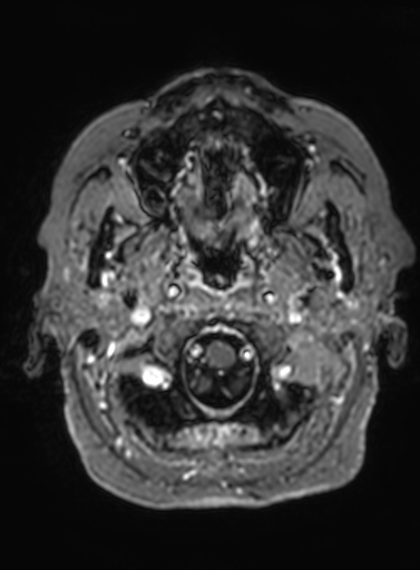 File:Cavernous hemangioma of the cerebellar falx (Radiopaedia 73025-83724 Axial T1 C+ 319).jpg