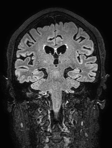 Cavernous hemangioma of the cerebellar falx (Radiopaedia 73025-83724 Coronal FLAIR 202).jpg