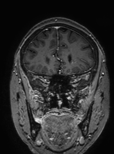 Cavernous hemangioma of the cerebellar falx (Radiopaedia 73025-83724 Coronal T1 C+ 109).jpg