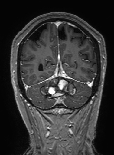 Cavernous hemangioma of the cerebellar falx (Radiopaedia 73025-83724 Coronal T1 C+ 294).jpg