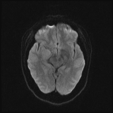 File:Cavernous sinus meningioma (Radiopaedia 63682-72367 DWI 31).jpg