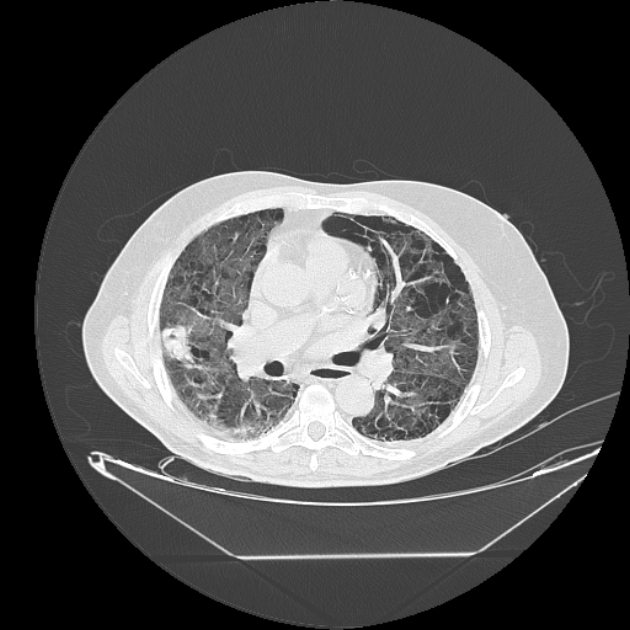 Cavitating bronchogenic carcinoma (Radiopaedia 44489-48162 Axial lung window 40).jpg