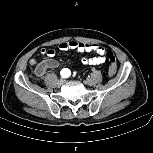 File:Cecal cancer with appendiceal mucocele (Radiopaedia 91080-108651 Axial C+ delayed 57).jpg