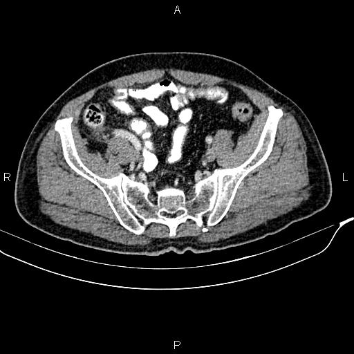 File:Cecal cancer with appendiceal mucocele (Radiopaedia 91080-108651 B 83).jpg