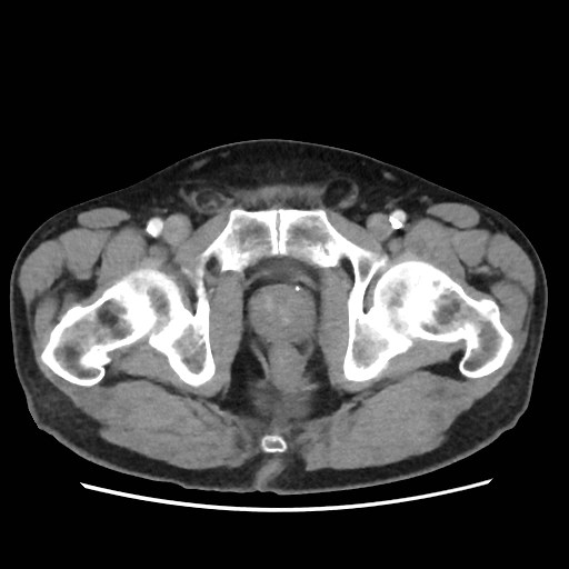 Cecal mass causing appendicitis (Radiopaedia 59207-66531 A 87).jpg