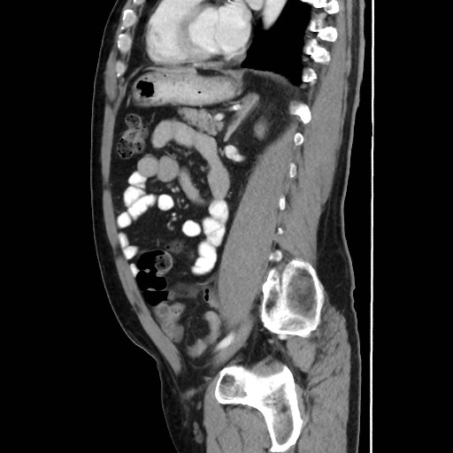 Cecal mass causing appendicitis (Radiopaedia 59207-66531 C 41).jpg