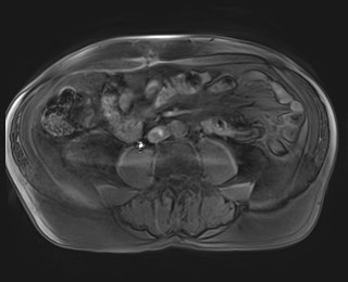Cecal mass causing appendicitis (Radiopaedia 59207-66532 K 80).jpg