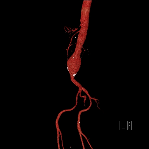 File:Celiac artery compression by the diaphragmatic crurae (Radiopaedia 31739-32666 3D CTA 13).jpg