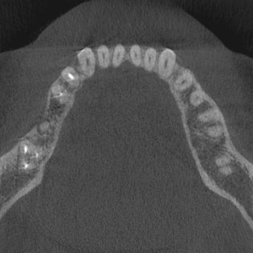 Cemento-osseous dysplasia (Radiopaedia 48251-53126 Axial non-contrast 42).jpg