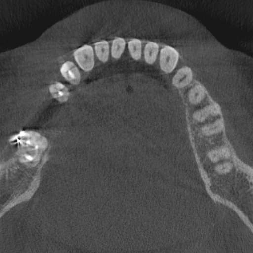 Cemento-osseous dysplasia (Radiopaedia 48251-53126 Axial non-contrast 49).jpg
