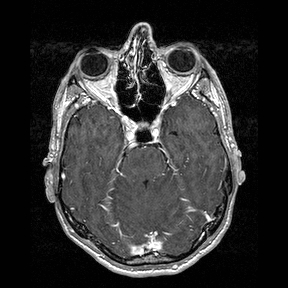 Central-variant posterior reversible encephalopathy syndrome (PRES) (Radiopaedia 43880-47358 Axial T1 C+ 46).jpg