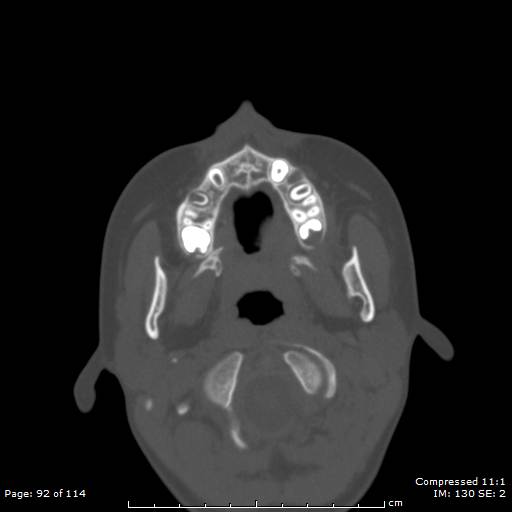 File:Central giant cell granuloma (Radiopaedia 45612-49754 Axial bone window 46).jpg