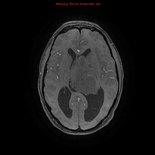 Central neurocytoma (Radiopaedia 13188-13206 Axial MRA 37).jpg