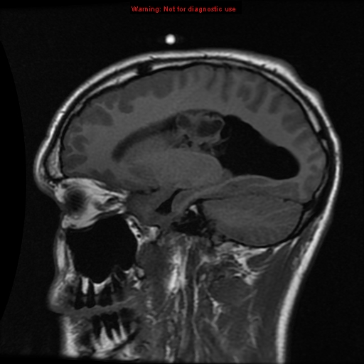File:Central neurocytoma (Radiopaedia 13188-13206 Sagittal T1 13).jpg