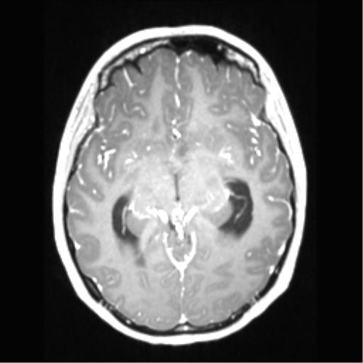 Central neurocytoma (Radiopaedia 37664-39557 Axial T1 C+ 36).png