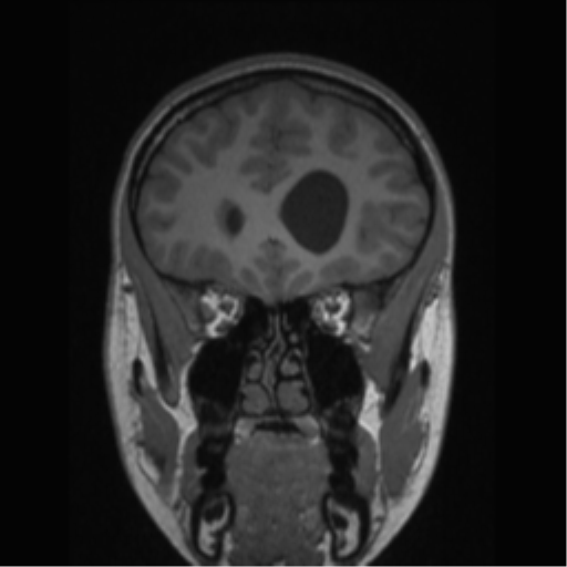 Central neurocytoma (Radiopaedia 37664-39557 Coronal T1 66).png