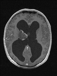 Central neurocytoma (Radiopaedia 56690-63469 Axial T1 C+ 90).jpg