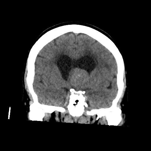 File:Central neurocytoma (Radiopaedia 65317-74346 Coronal non-contrast 26).png