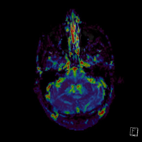 Central neurocytoma (Radiopaedia 84497-99872 Axial Perfusion 257).jpg
