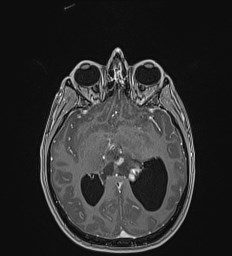 File:Central neurocytoma (Radiopaedia 84497-99872 Axial T1 C+ 75).jpg
