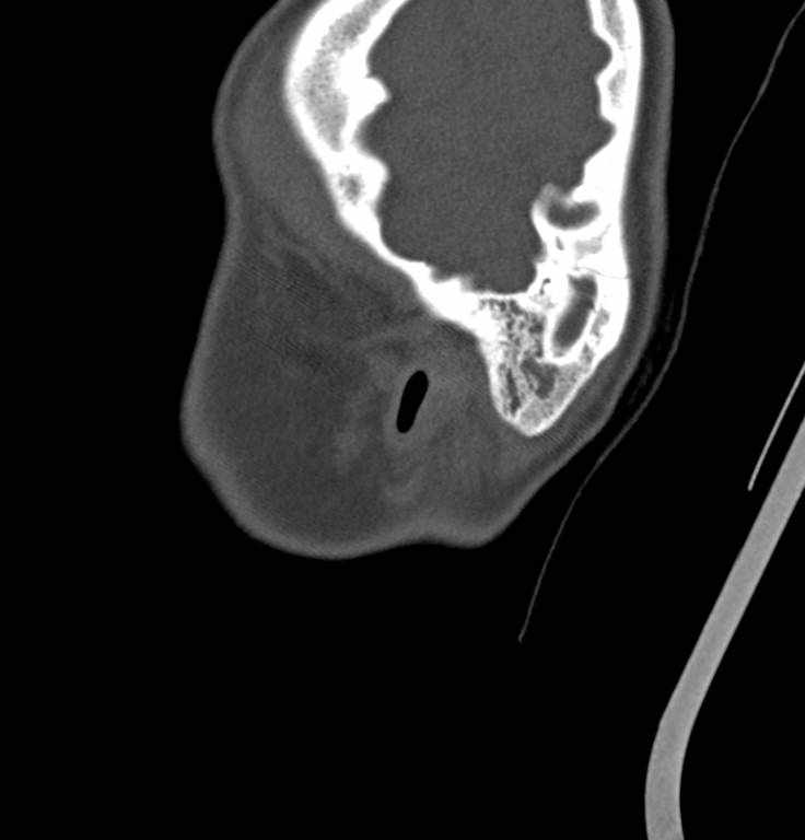 Cerebellar abscess (Radiopaedia 73727-84527 Sagittal bone window 42).jpg