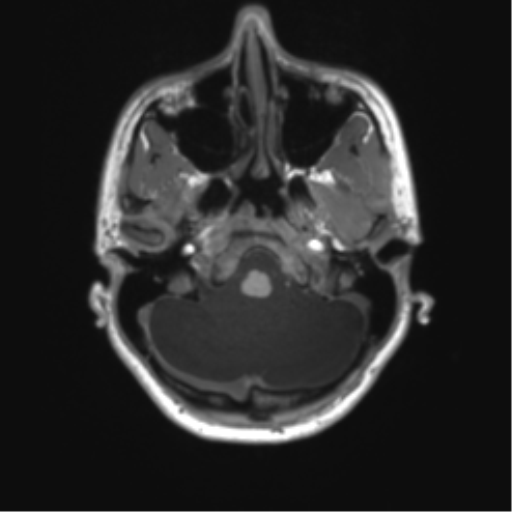 Cerebellar agenesis with hypoplastic pons (pontocerebellar hypoplasia) (Radiopaedia 57224-64138 Axial T1 17).png