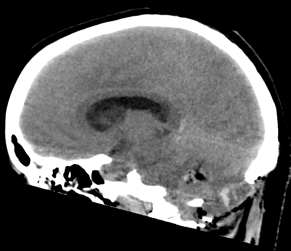 File:Cerebellar ependymoma complicated by post-operative subdural hematoma (Radiopaedia 83322-97737 C 17).png