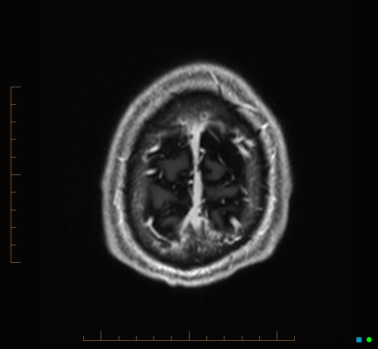 Cerebellar gangliocytoma (Radiopaedia 65377-74422 Axial T1 C+ 135).jpg