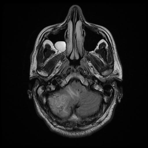 File:Cerebellar hemangioblastoma (Radiopaedia 88055-104622 Axial FLAIR 7).jpg