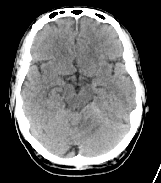 File:Cerebellar hemorrhage (Radiopaedia 37000-38669 Axial non-contrast 16).png